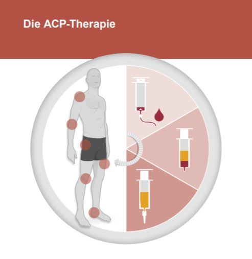 Schema ACP-Therapie